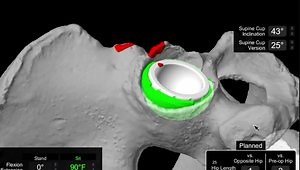 Robotic-Assisted Total Hip Replacement: Get It Perfect Every Time