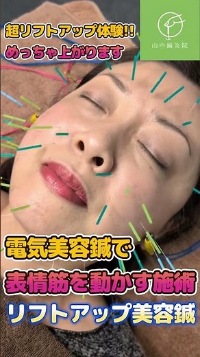 【美容革命】顔が引き上がる瞬間がハッキリ見える電気美容鍼