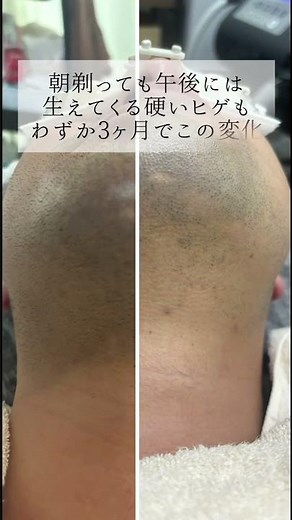 ヒゲ脱毛6回の変化