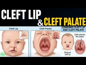 Cleft Lip and Cleft Palate: Embryology, Clinical Features, Diagnosis, and Management