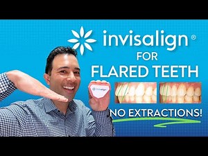 Fix Your Flared Teeth With Invisalign WITHOUT Extractions! (Invisalign and IPR Method)