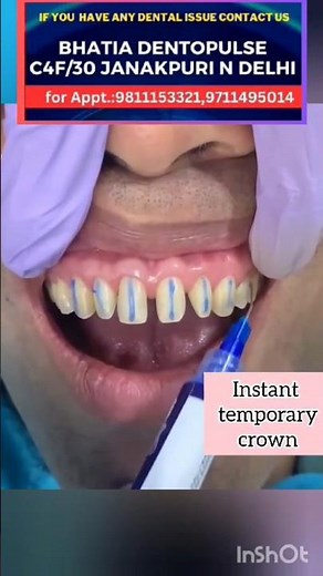 INSTANT Temporary Crown #newteeth #teeth #dentist