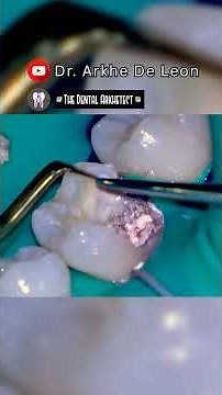 Restoring a Very Deep Seated Caries on a Root Canal Treated Tooth #4k #dentist #C83 P1