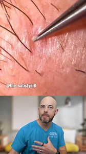 127K views · 402 reactions | This pustule pop tricked me! (credit: @the_satisfyer0 on TT) #skincare #satisfying | Dr. Dustin Portela, Dermatologist | Facebook