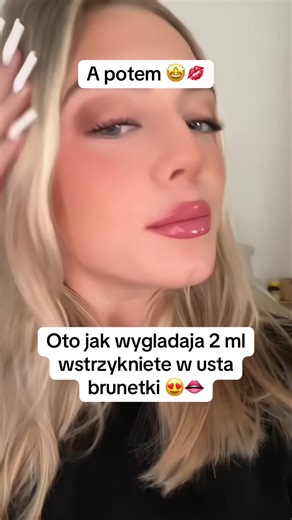 Sekrety pięknych ust: Zastrzyki vs. Neoparin