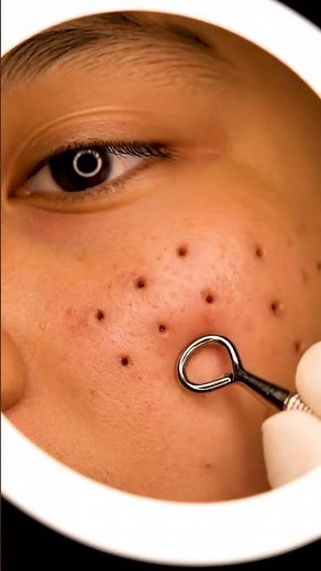Relax Every Day, Spa Facial Treatment, Blackhead Extraction, Removal,ASMR, Relaxing Spa#1