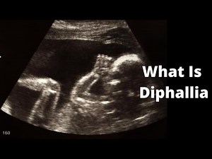 What Is Diphallia
