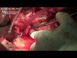 Whipple procedure (pancreatoduodenectomy) on complicated patient • Video • MEDtube.net