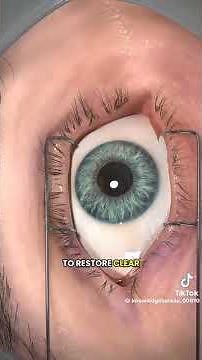 How Cataracts Surgical Operation is Done
