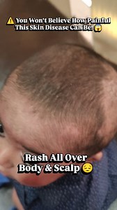  His Whole Body Covered in Rash — The Truth About Atopic Dermatitis...