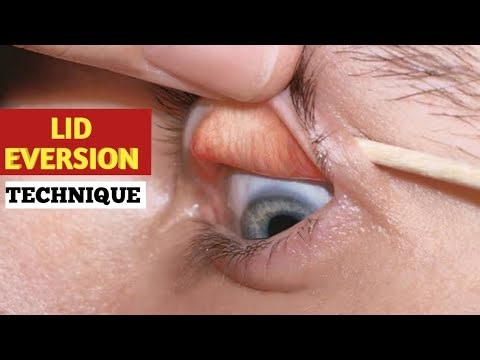 How to fold eyelids | lid eversion techniques explained indetail ‪@eyecareoptom5506‬ #eyelid #eyes