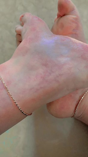 Understanding Skin Irritation on Feet: Causes and Care