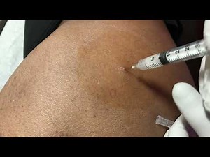 How to inject IT Band Syndrome- ITBS on the hip