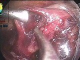 Suture Ligation in Lap Varicocelectomy Total Reduced Size • Video • MEDtube.net