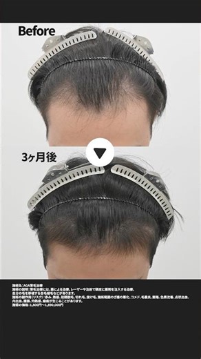 3ヶ月で生え際どこまで変わる⁉️#aga治療 #aga治療薬 #フィナステリド #ミノキシジル #毛根再生注射 #湘南agaクリニック #湘南agaクリニック池袋院