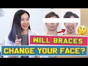 Will Braces Change Your FACE? | #BraceYourself​!🦷