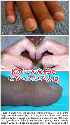 身体所見診察: バチ指とは、ばち指の原因と見分け方