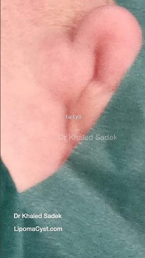 Ear Cyst #shorts Dr Khaled Sadek. LipomaCyst.com