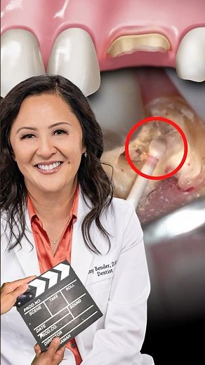 CAVITY Removal and FILLING on a MOLAR #dentistry