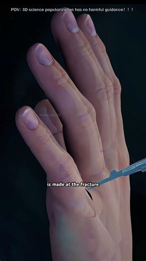 How Finger Fracture Surgery Is Performed (3D Animation)#fingerfracture#medical3danimation