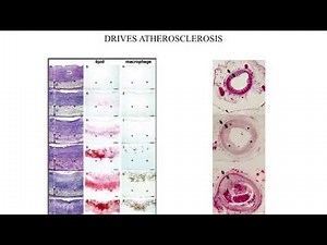 Polyenylphosphatidylcholine (PPC) in Cardiovascular Disease and Integrative Medicine - Part Two