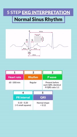 Nurse Mike from Simple Nursing on Instagram: "5-Step EKG Interpretation - Part 2!🫀"