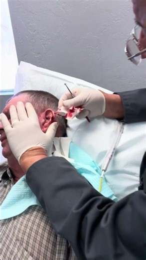 Dr. B Shows what cancer on ear that needs to be removed looks like