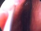 Septoplasty - Endoscopy • Video • MEDtube.net