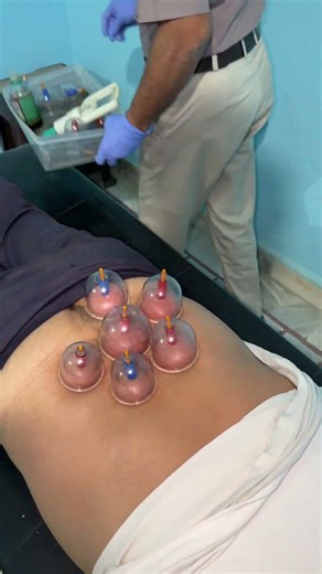 Low back pain treatment cupping
