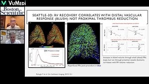Considerations for Acute Pulmonary Embolism Endovascular Therapy: An Expert Clinical Discussion