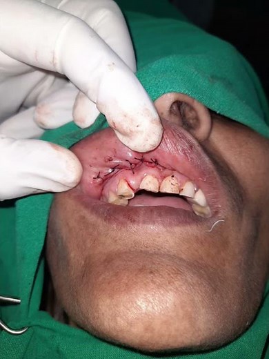 Nasolabial cyst surgery,caldwell luc approach(14/3/2021)(surgical video)