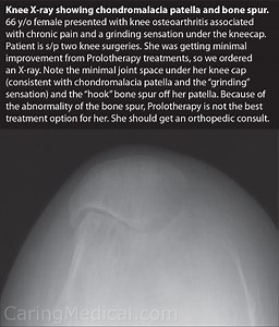 Patellofemoral Pain Syndrome and chondromalacia patella