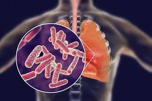 Pneumonie : quels sont ses symptômes, sa contagion, ses causes, ses traitements ?