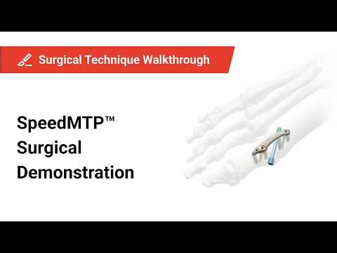 SpeedMTP® Surgical Demonstration: Step-by-Step 1st MTP Joint Arthrodesis