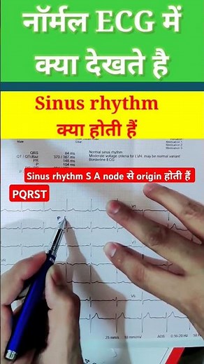 Normal ecg कैसे देखते हैं l Sinus rhythm ecgl #ecg #echo #shorts