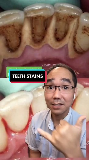 Effective Ways to Remove Tea and Coffee Stains on Teeth