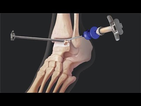 Outcomes for BioCartilage® Extracellular Matrix Versus Microfracture for Talar Osteochondral Lesions