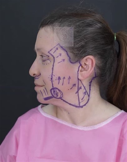 Ismael Faqih on Instagram‎: "تاکو ئێستا ئەنجامی وات بینیوە؟! 51-year-old lady | 3 months post HybridFacelift™️ Three months after surgery, the results speak for themselves—dramatic, natural, and beautifully balanced facial rejuvenation. • Procedure: HybridFacelift™️ • Anesthesia: General • Operating time: 6 hours A refreshed contour, improved jawline and neck definition, and long-lasting rejuvenation—all achieved with precision and artistry. Do you like the results? 👉 Yes or No? Write your answ