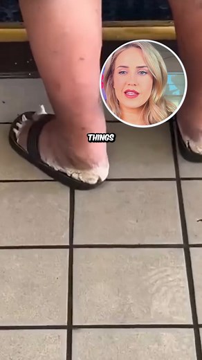 1.5M views · 3.7K reactions | Have you seen calluses like this? #callus #foothealth #doctorreacts #footcallus | Footdocdana | Facebook