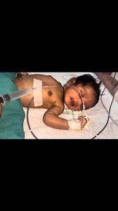 Newborn Baby NG Tube Placement, Stomach Washing, and Tube Removal in NICU #nicucare #baby #fetus #newbornassessment #newborn | Gautam Ashish