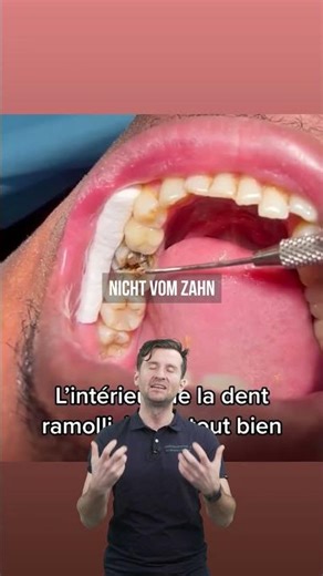 Potential problems with amalgam fillings