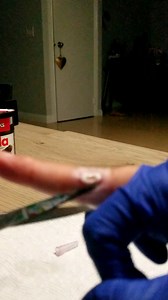 UPDATE: removal after compound w bandaid