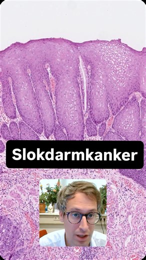 Dr.Pathologica | Het adenocarcinoom van de slokdarm ontstaat uit dysplastisch intestinaal metaplastisch epitheel. | Instagram