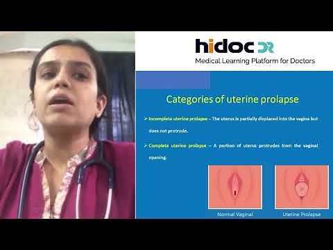 Stages of Uterine Prolapse - By Dr. Archana Kamath
