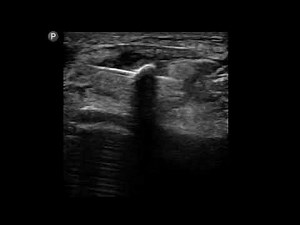 Knee Ultrasound: Patellar Tendon Barbotage