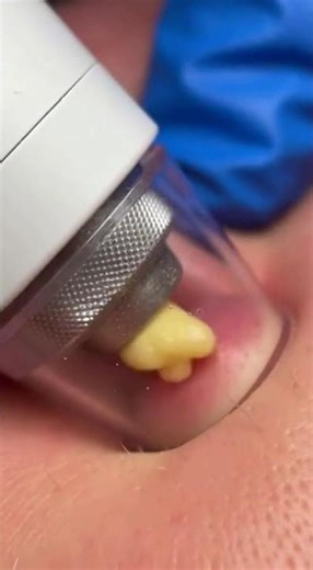 Largest Blackhead Removal You'll See Today #shorts #satisfying #extraction