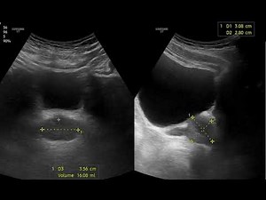 Prostate volume measurement: Why two measurements in Longitudinal and One in transverse?
