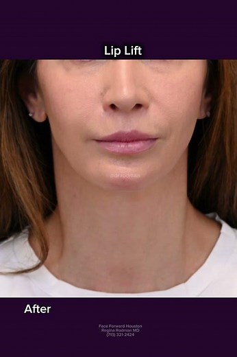 Lip Lift| Before and After| Plastic Surgery