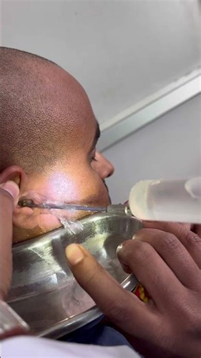 Ear syringing #shorts#earwaxremoval #earcleaning