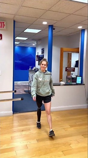 Vicky Walking with an Above-Knee Prosthesis and 3D-Printed Cover